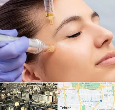 میکرونیدلینگ در مرزداران