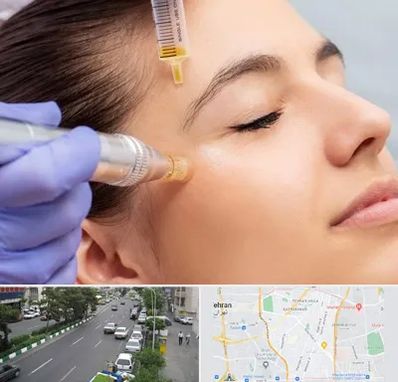 میکرونیدلینگ در ستارخان