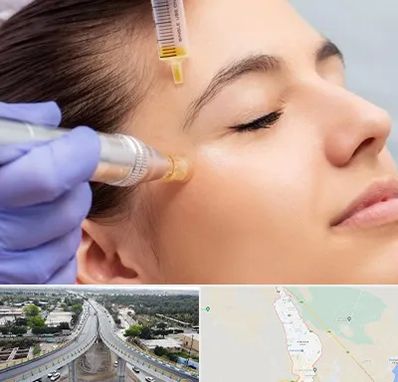 میکرونیدلینگ در اندیمشک