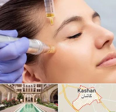 میکرونیدلینگ در کاشان