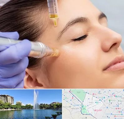 میکرونیدلینگ در کوهسنگی مشهد