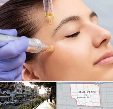 میکرونیدلینگ در خیابان جمالزاده