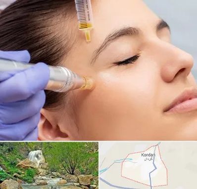 میکرونیدلینگ در کردان