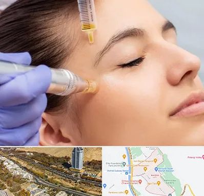 میکرونیدلینگ در خیابان نیایش شیراز