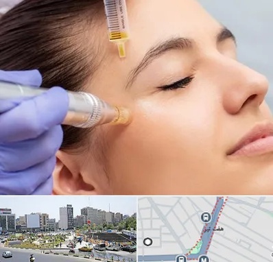 میکرونیدلینگ در هفت تیر