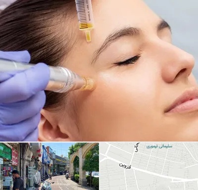 میکرونیدلینگ در خیابان قزوین