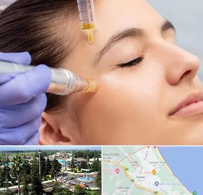 میکرونیدلینگ در رودسر