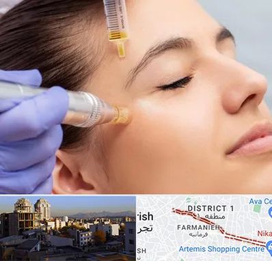 میکرونیدلینگ در فرمانیه