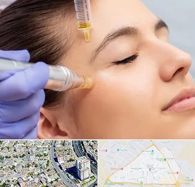 میکرونیدلینگ در قاسم آباد مشهد