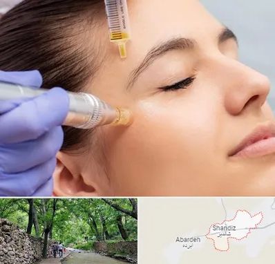 میکرونیدلینگ در شاندیز مشهد