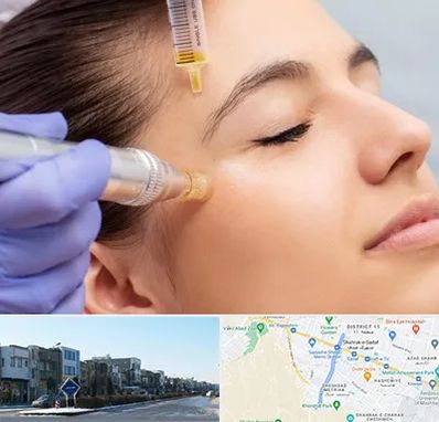 میکرونیدلینگ در شریعتی مشهد