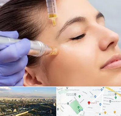 میکرونیدلینگ در هنگام