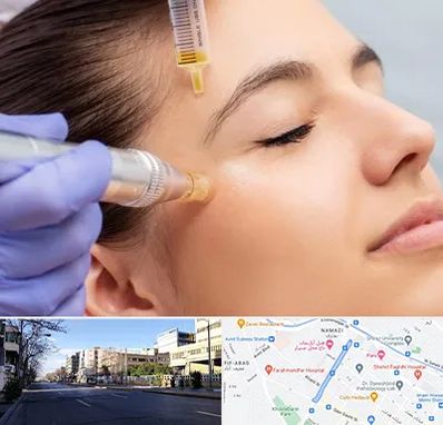 میکرونیدلینگ در خیابان ملاصدرا شیراز