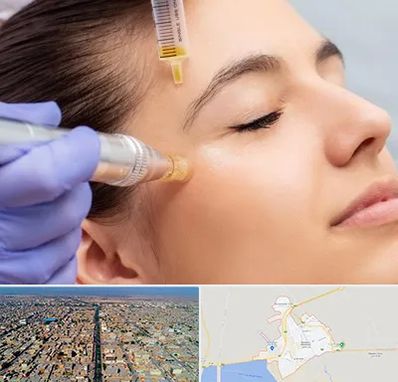 میکرونیدلینگ در بندر ماهشهر