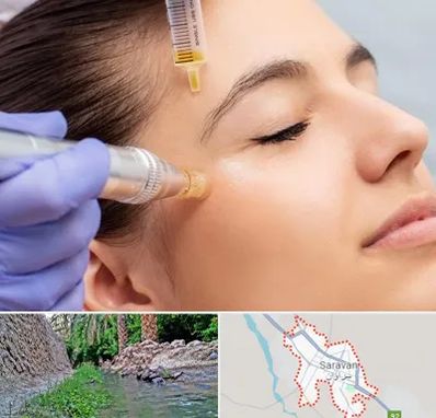 میکرونیدلینگ در سراوان
