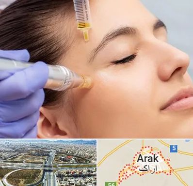 میکرونیدلینگ در اراک