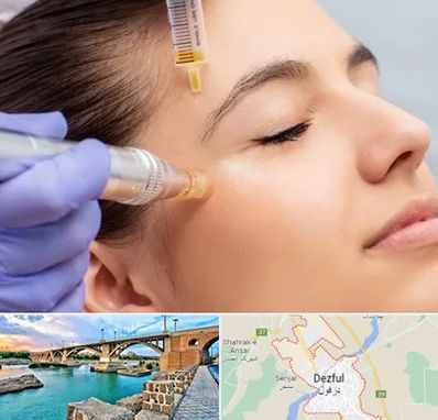 میکرونیدلینگ در دزفول