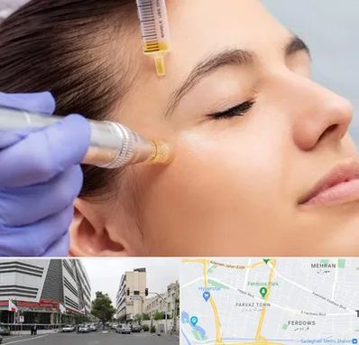 میکرونیدلینگ در بلوار فردوس