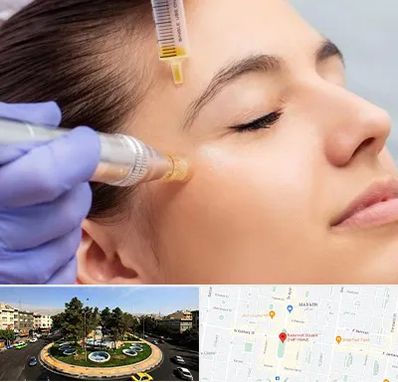 میکرونیدلینگ در هفت حوض