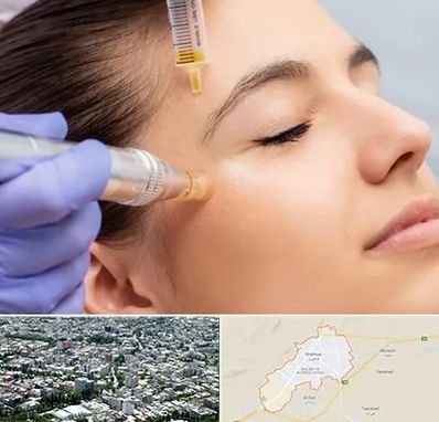 میکرونیدلینگ در شاهرود