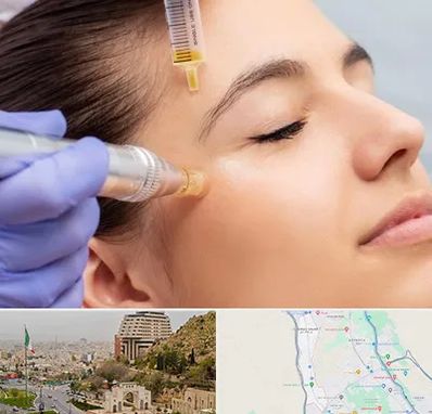 میکرونیدلینگ در فرهنگ شهر شیراز