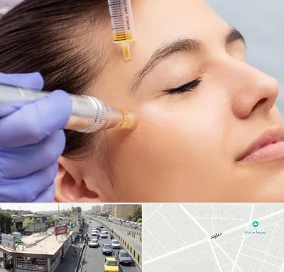 میکرونیدلینگ در خیابان دماوند
