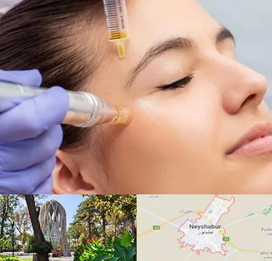 میکرونیدلینگ در نیشابور