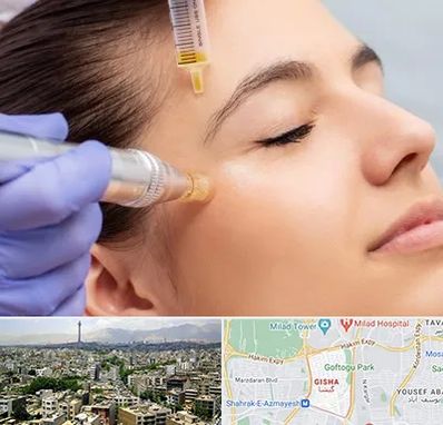 میکرونیدلینگ در گیشا