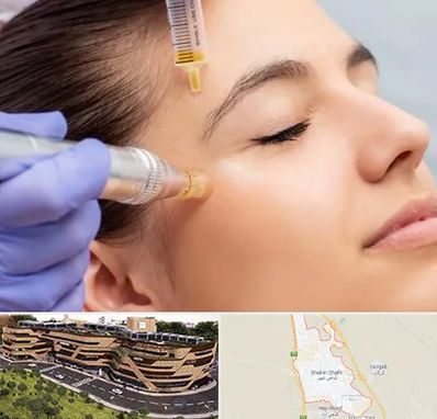 میکرونیدلینگ در شاهین شهر
