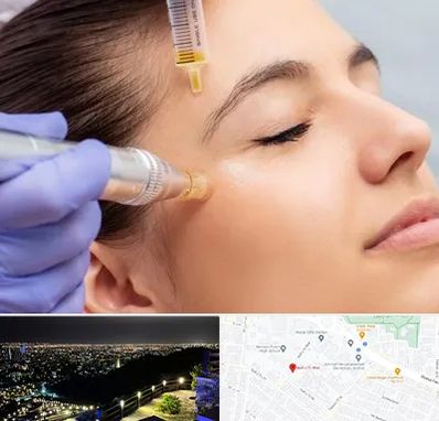 میکرونیدلینگ در هفت تیر مشهد