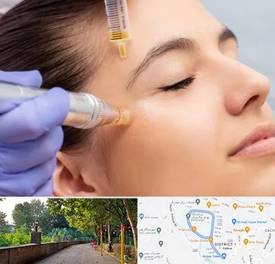 میکرونیدلینگ در بلوار گیلان رشت