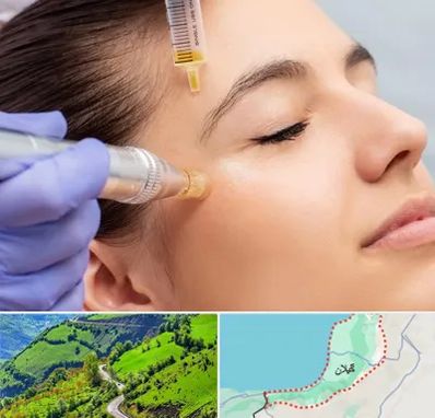 میکرونیدلینگ در گیلان