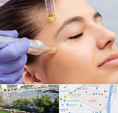 میکرونیدلینگ در گلستان اهواز