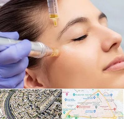 میکرونیدلینگ در شهرک غرب مشهد