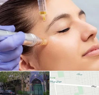 میکرونیدلینگ در بریانک
