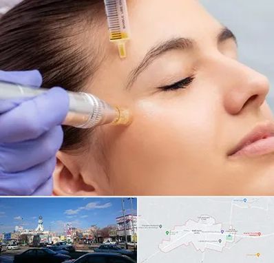 میکرونیدلینگ در ماهدشت کرج