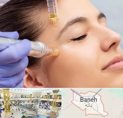 میکرونیدلینگ در بانه