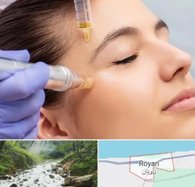 میکرونیدلینگ در رویان