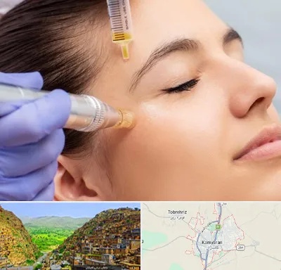 میکرونیدلینگ در کامیاران