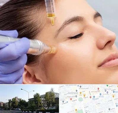 میکرونیدلینگ در میدان کاج