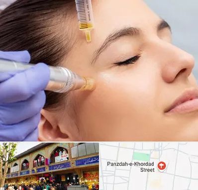 میکرونیدلینگ در 15 خرداد