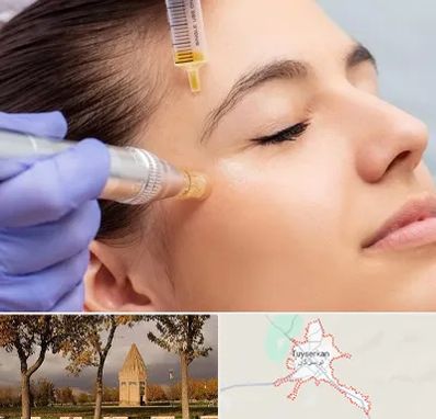 میکرونیدلینگ در تویسرکان