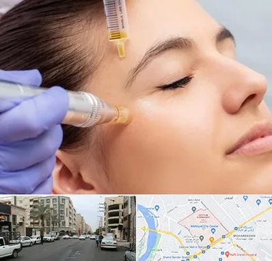 میکرونیدلینگ در زیتون کارمندی اهواز