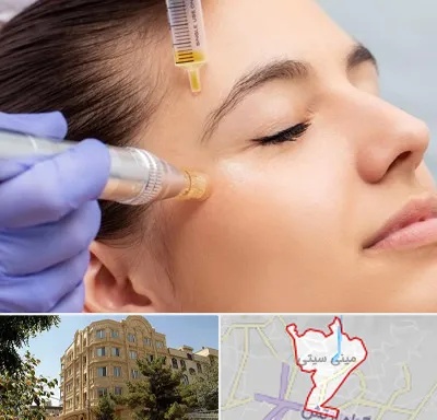 میکرونیدلینگ در مینی سیتی