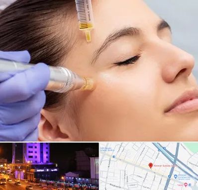 میکرونیدلینگ در آبرسان تبریز