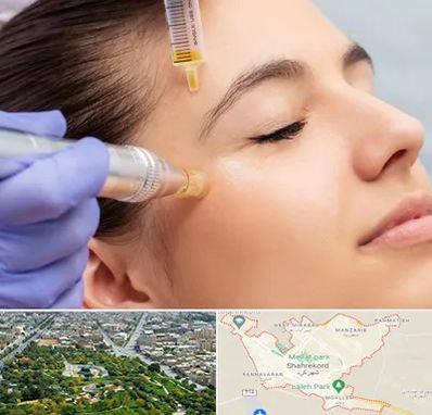 میکرونیدلینگ در شهرکرد