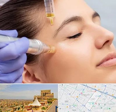 میکرونیدلینگ در هاشمیه مشهد