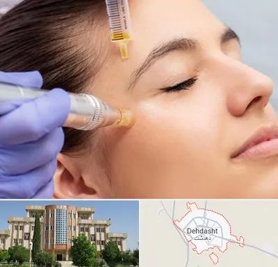 میکرونیدلینگ در دهدشت