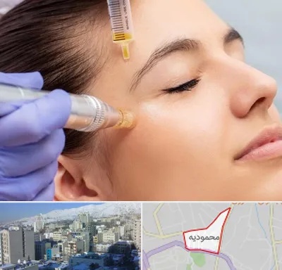میکرونیدلینگ در محمودیه