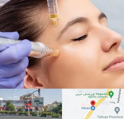 میکرونیدلینگ در هروی